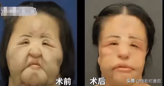 整容成癮韓慧景：把臉整得面目全非，給自己注射機油，後悔莫及