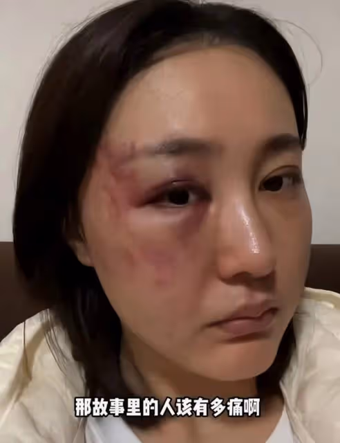 徐大寶慘遭家暴後首曬近況！用頭髮口罩擋疤痕，暴瘦不敢認太心酸