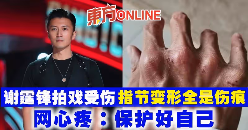 謝霆鋒拍戲受傷　指節變形全是傷痕　網心疼：保護好自己