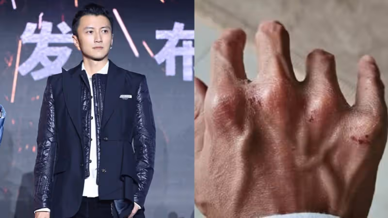 謝霆鋒拍戲受傷　手嚴重變形、關節明顯突出