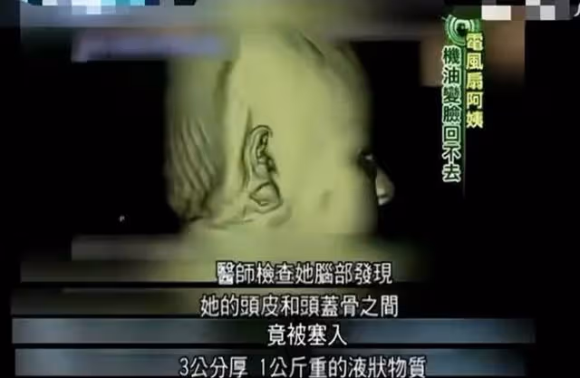 2018年韓慧景悽慘離世,曾在臉部注射色拉油,因整容過度幾乎毀容