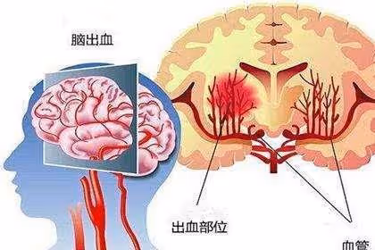 知名影后因腦出血心臟驟停,手術難挽回生命,為何會如此?