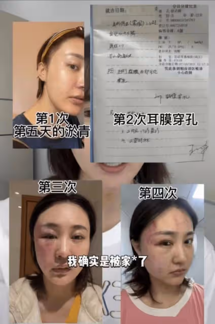 女明星趙敏雅疑似遭家暴，自曝被抓頭往地上摔，休克搶救後再被打