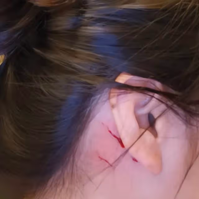 突發!香港知名女星被豹貓抓傷血痕累累,緊急就醫打破傷風針