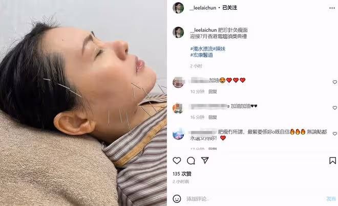 56歲李麗珍曬針灸瘦臉照,自嘲是肥珍!失戀後患抑鬱症一度暴肥