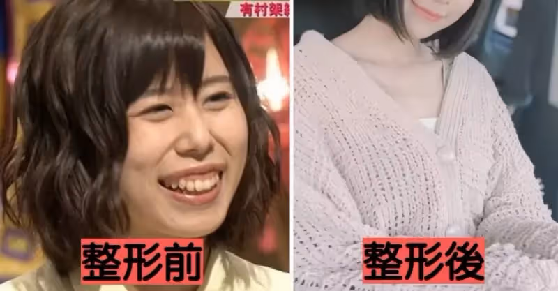 自卑到不敢笑！暴牙凸嘴女星「被酸長得像蟑螂」 　砸100萬整形變「甜美大眼正妹」網驚：笑容好美
