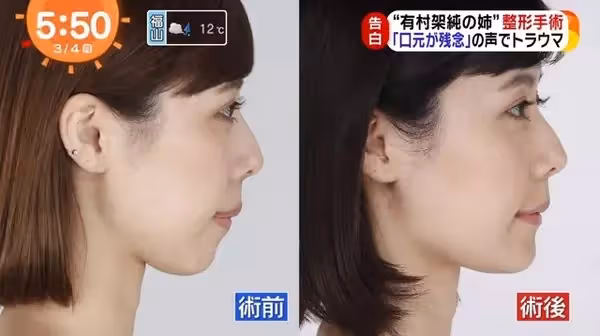 自卑到不敢笑!暴牙凸嘴女星「被酸長得像蟑螂」 砸100萬整形變「甜美大眼正妹」網驚:笑容好美