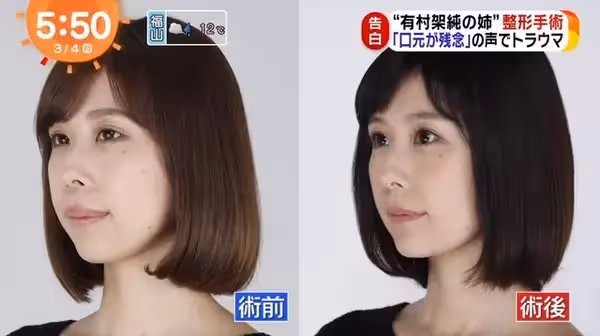 自卑到不敢笑!暴牙凸嘴女星「被酸長得像蟑螂」 砸100萬整形變「甜美大眼正妹」網驚:笑容好美