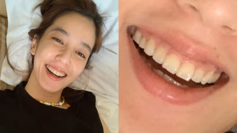 練舉重咬牙太用力　陳庭妮咬斷一小角門牙