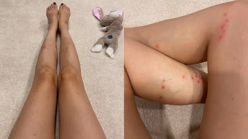 愛美穿露腿潛水裝　潘慧如慘被水母螫傷