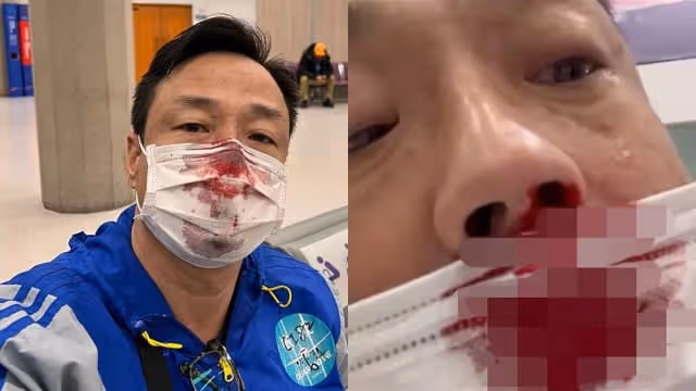 黃秋生台灣做PCR檢測　像王喜一樣被捅到出血