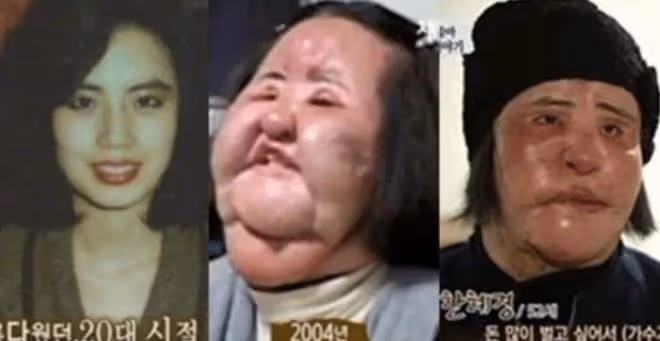 她天生麗質卻痴戀整容，後因意外導致毀容，去世時年僅57歲