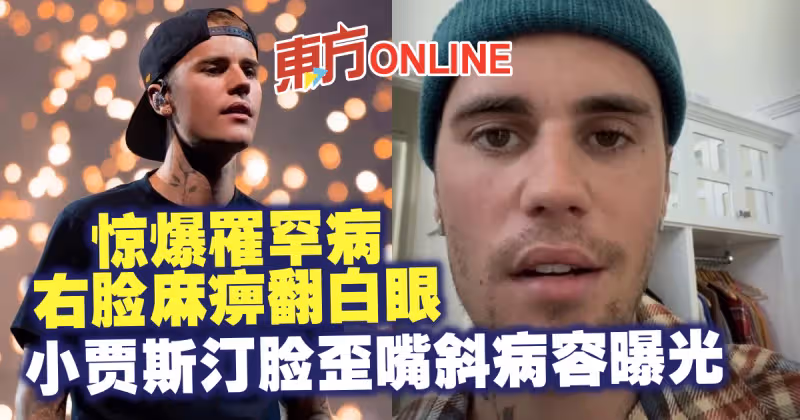 驚爆罹罕病右臉麻痹翻白眼　小賈斯汀臉歪嘴斜病容曝光