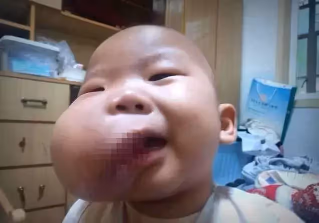 2歲男童患重病,臉頰腫大如嬰兒頭。媽媽:沒有錢就只能等死嗎?