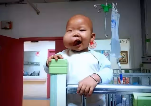 2歲男童患重病,臉頰腫大如嬰兒頭。媽媽:沒有錢就只能等死嗎?
