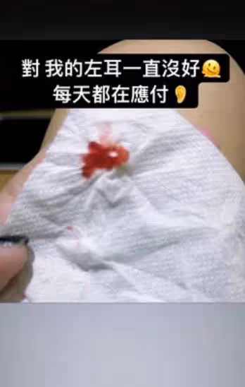 左耳聽力剩兩成　黃美珍曬耳朵流血照超無奈