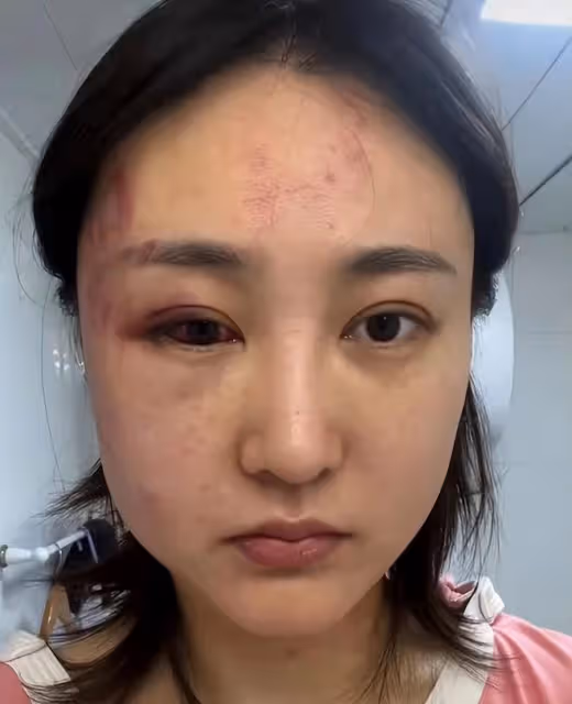 34歲女星遭家暴後現身派出所！打到眼出血被鑑定輕傷，老公已拘留