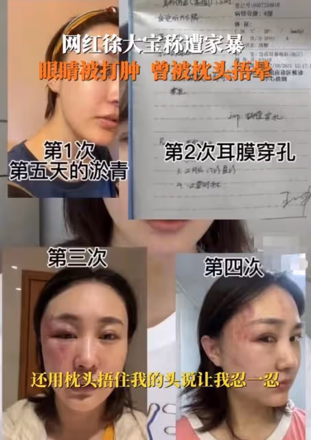 34歲女星遭家暴後現身派出所!打到眼出血被鑑定輕傷,老公已拘留