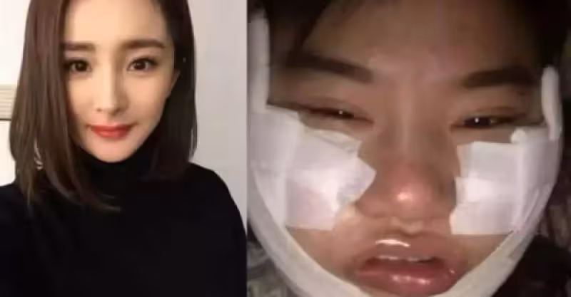 女大生「砸450萬整型」為了變楊冪， 紗布拆下後，網友驚：比楊冪還還美