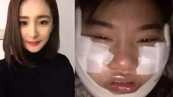 女大生「砸450萬整型」為了變楊冪， 紗布拆下後，網友驚：比楊冪還還美