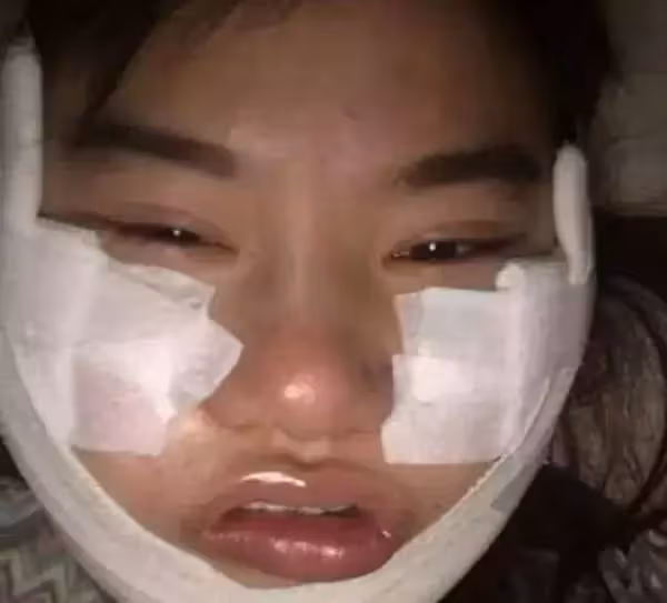 女大生「砸450萬整型」為了變楊冪， 紗布拆下後，網友驚：比楊冪還還美