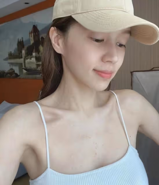 禍不單行！TVB人氣小花胸口長滿紅色小疙瘩，睡覺更受蚊蟲叮咬