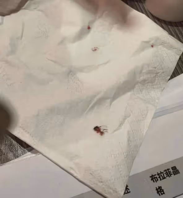 禍不單行！TVB人氣小花胸口長滿紅色小疙瘩，睡覺更受蚊蟲叮咬