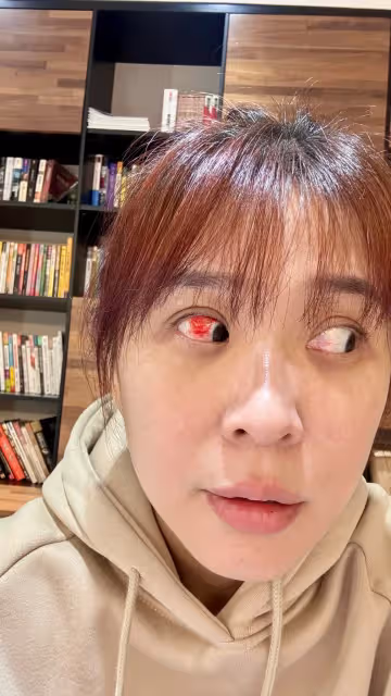 本土劇女神眼球爆血　慘不忍睹照曝光！網看傻：快就醫