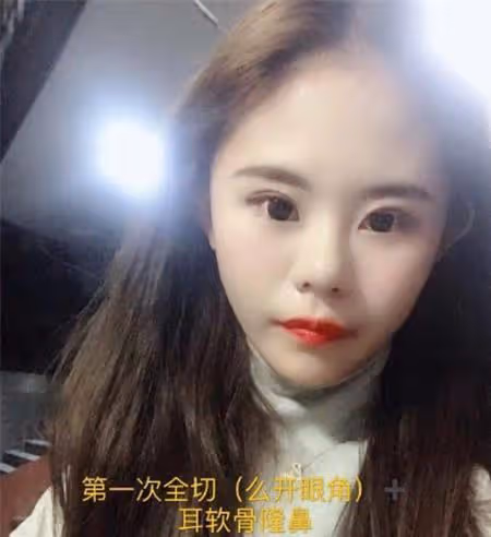 女孩為了變美,花100萬瘋狂整容,揚言母親支持,前後對比如換臉