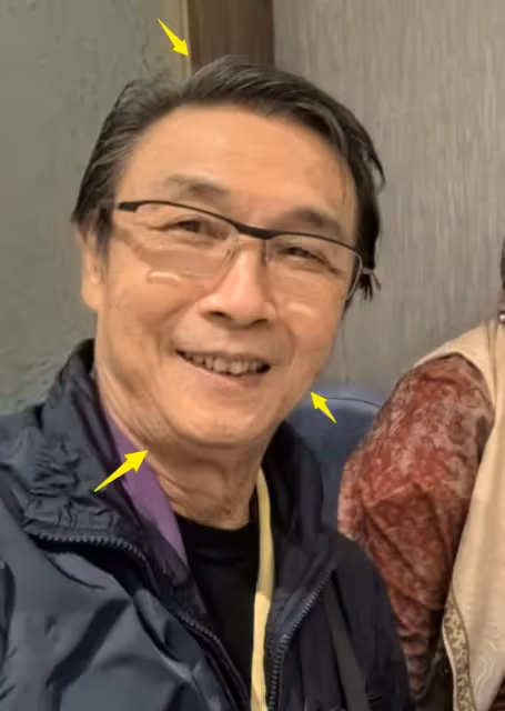 74歲劉松仁瘦脫相,口齒不清疑中風,堅持丁克晚年淒涼!