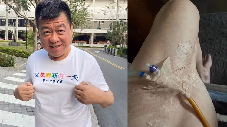 「王牌經紀人」抗癌術後自綁尿袋　自嘲成孤單老人