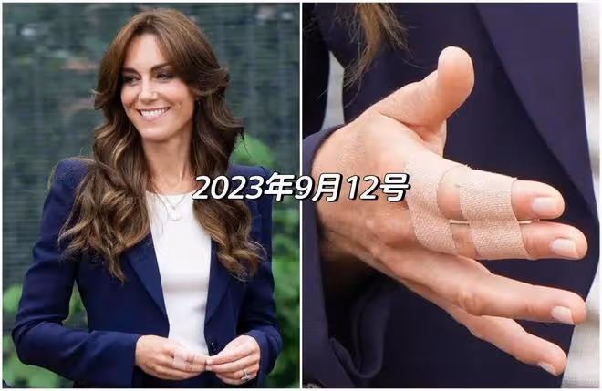 英媒曝威廉有暴力傾向,凱特疑遭其家暴去世,此前手上多次有傷!
