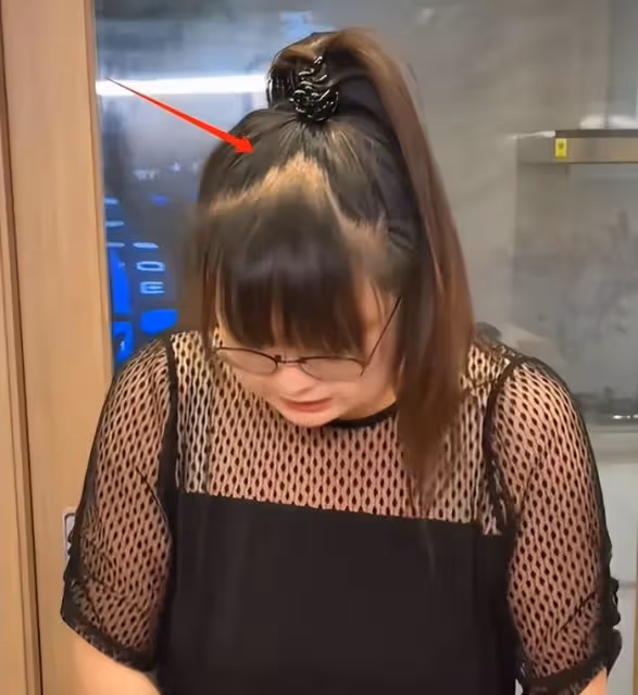 港星陳嘉佳減肥後遺症曝光！聳肩、脫髮、站不穩，連累賈玲遭質疑