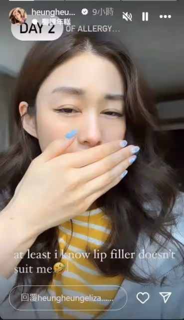 TVB花旦突發嚴重過敏慘變孖潤嘴，當全職媽媽三年後宣布全面復出