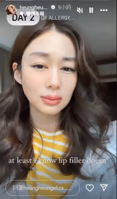 TVB花旦突發嚴重過敏慘變孖潤嘴，當全職媽媽三年後宣布全面復出