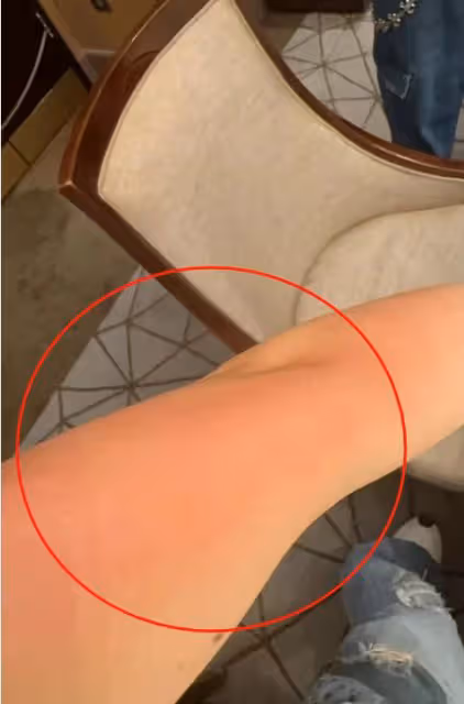 杜淳老婆帶女兒吃飯,左半身被沸湯燙傷,幸運及時跟孩子換了位置