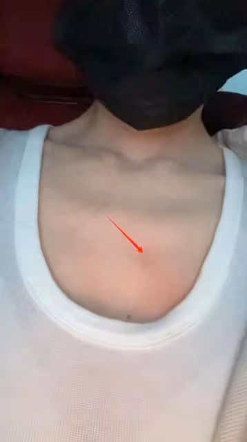 杜淳老婆帶女兒吃飯,左半身被沸湯燙傷,幸運及時跟孩子換了位置