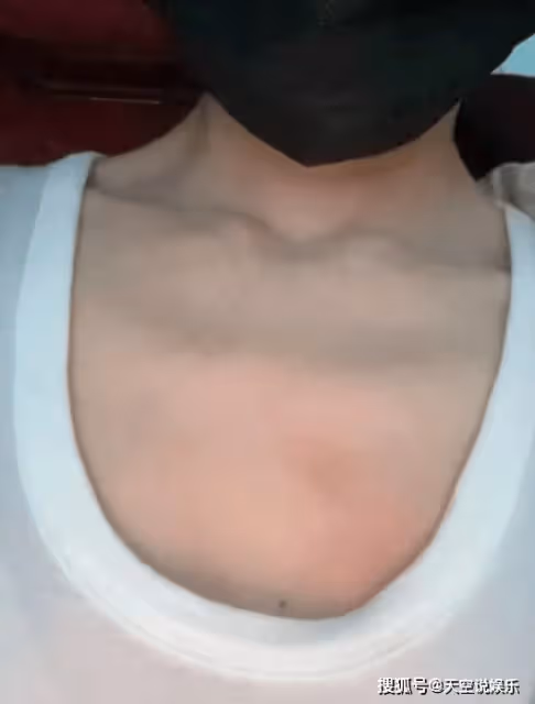 杜淳老婆餐廳吃飯被燙傷,現場一片狼藉,王燦手臂通紅:去急診了