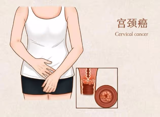 ​女人摘掉子宮後！和正常的女性有何不同　醫生說實話「有3個大變化」要提前護好健康