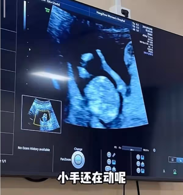 72張紀中陪孕妻產檢，四胎寶寶非常健康，老父親聽到胎心感動落淚