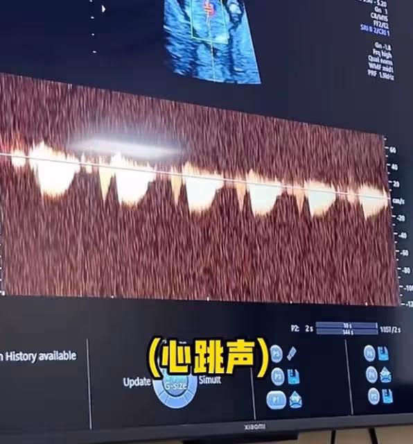 72張紀中陪孕妻產檢，四胎寶寶非常健康，老父親聽到胎心感動落淚