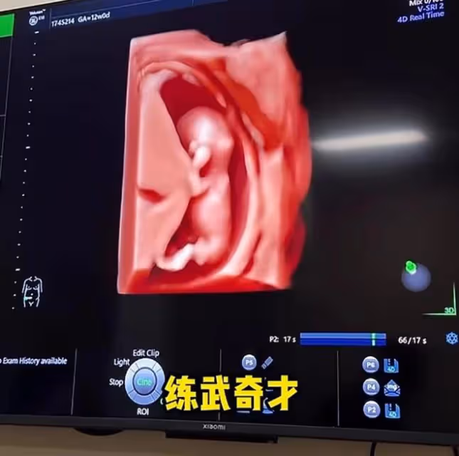 72張紀中陪孕妻產檢，四胎寶寶非常健康，老父親聽到胎心感動落淚