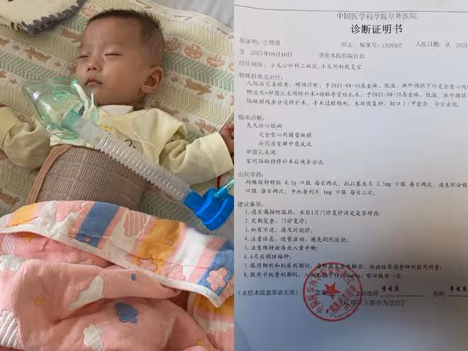 5個月產檢發現問題,夫妻不忍放棄,雙胞胎姐妹出生結果喜憂參半