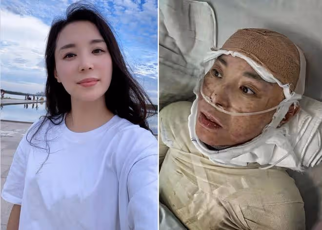 美媽凌晨拔火罐欲解酸痛,不料發生悲劇,從此全身戴上「緊箍咒」