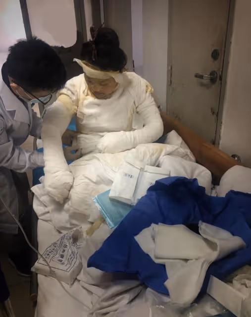 美媽凌晨拔火罐欲解酸痛,不料發生悲劇,從此全身戴上「緊箍咒」