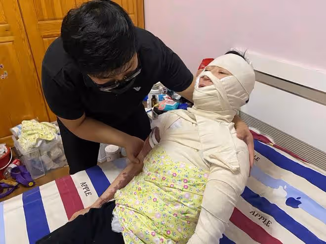 美媽凌晨拔火罐欲解酸痛,不料發生悲劇,從此全身戴上「緊箍咒」