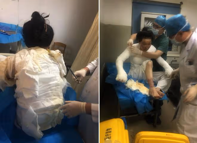 美媽凌晨拔火罐欲解酸痛,不料發生悲劇,從此全身戴上「緊箍咒」