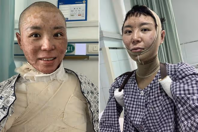 美媽凌晨拔火罐欲解酸痛,不料發生悲劇,從此全身戴上「緊箍咒」