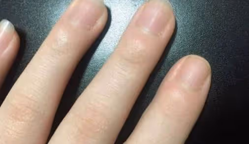 「月牙」越多，身體越好？許多人都理解錯了，看看自己屬於哪種