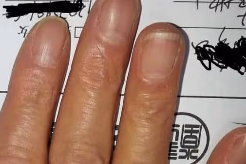「月牙」越多，身體越好？許多人都理解錯了，看看自己屬於哪種